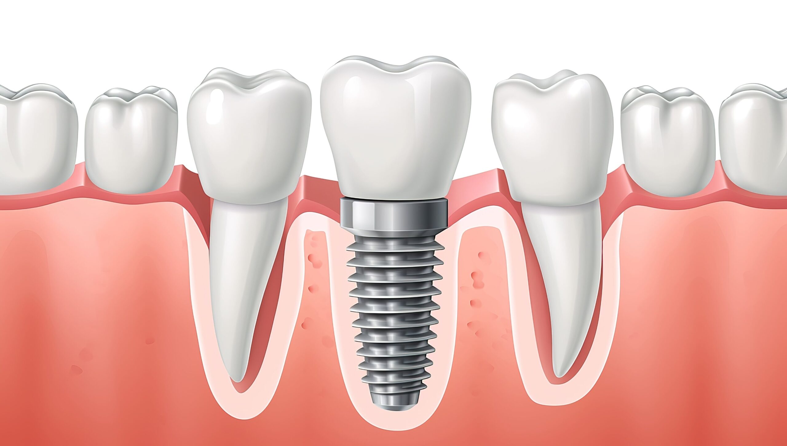 Single Tooth Dental Implants
