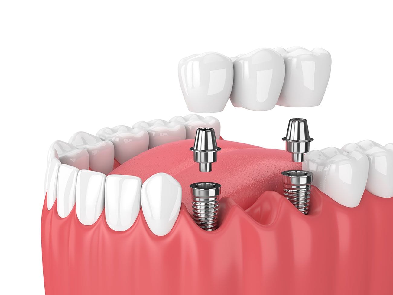 All-on-4 Dental Implants