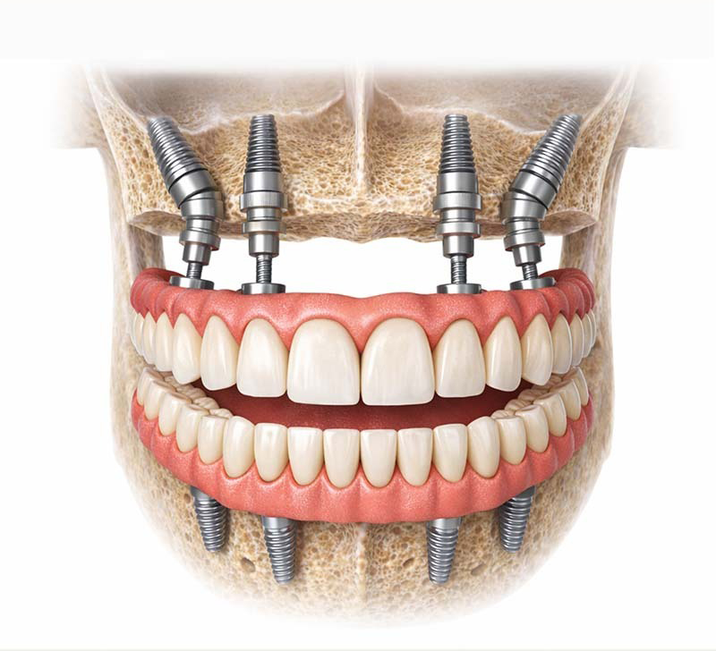 Wisdom Teeth Removal