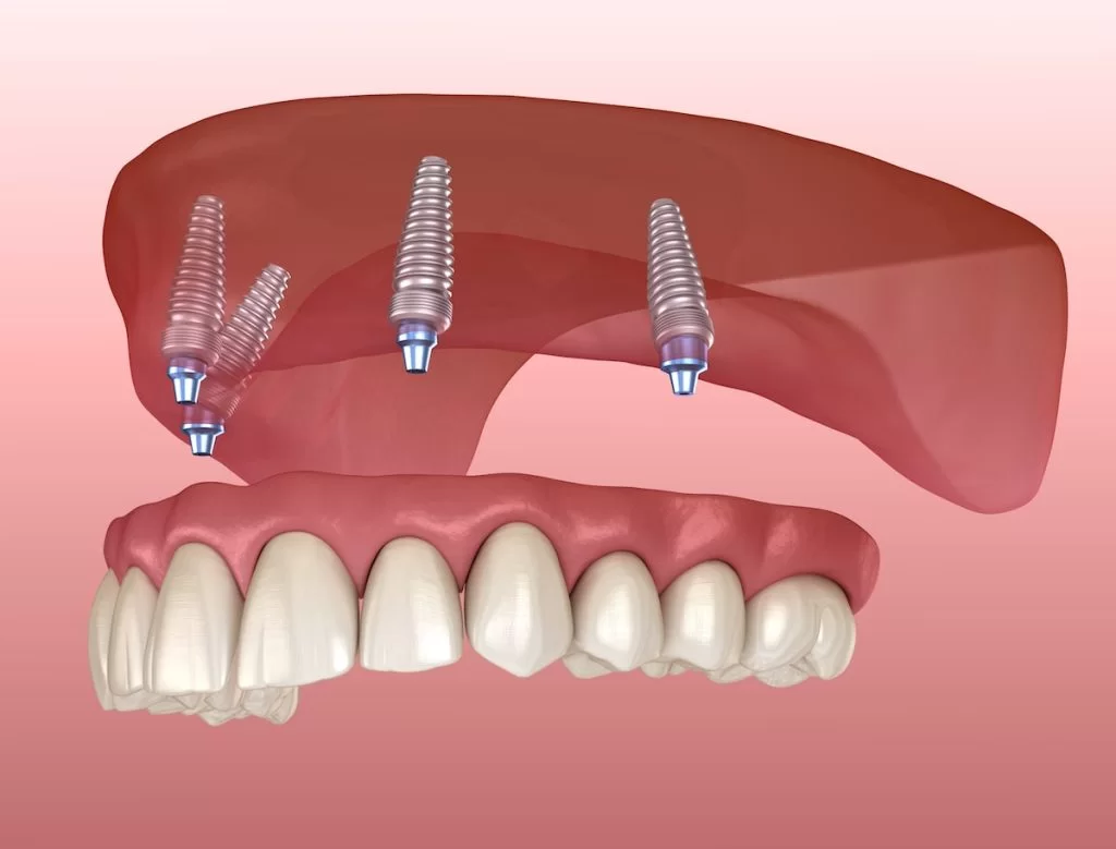 All On 4 Dental Implants