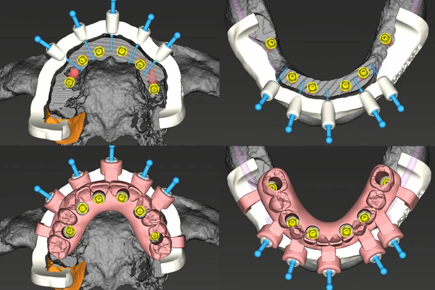 Personalized Digital Surgical Planning