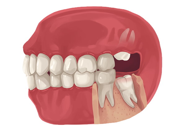 Wisdom Teeth Removal