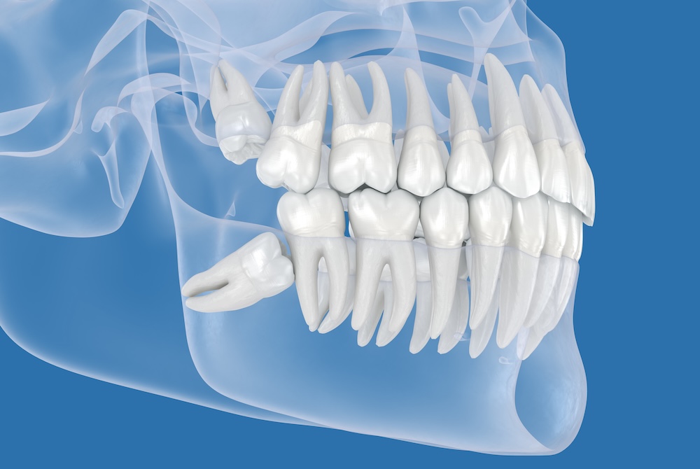 Wisdom Teeth Removal